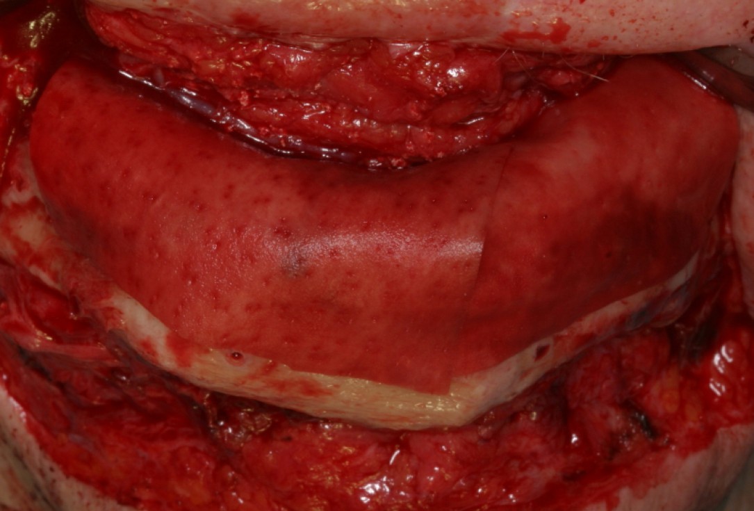Block augmentation with maxresorb®, collprotect® membrane & autologous bone blocks - Prof. Dr. Dr. D. Rothamel
