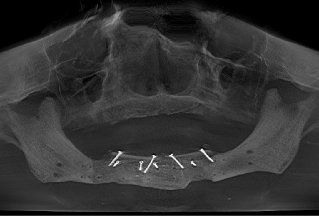 Block augmentation with maxresorb®, collprotect® membrane & autologous bone blocks - Prof. Dr. Dr. D. Rothamel