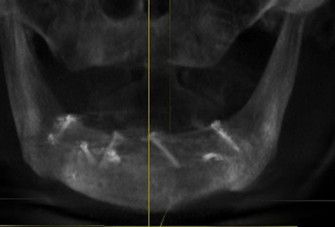 Block augmentation with maxresorb®, collprotect® membrane & autologous bone blocks - Prof. Dr. Dr. D. Rothamel