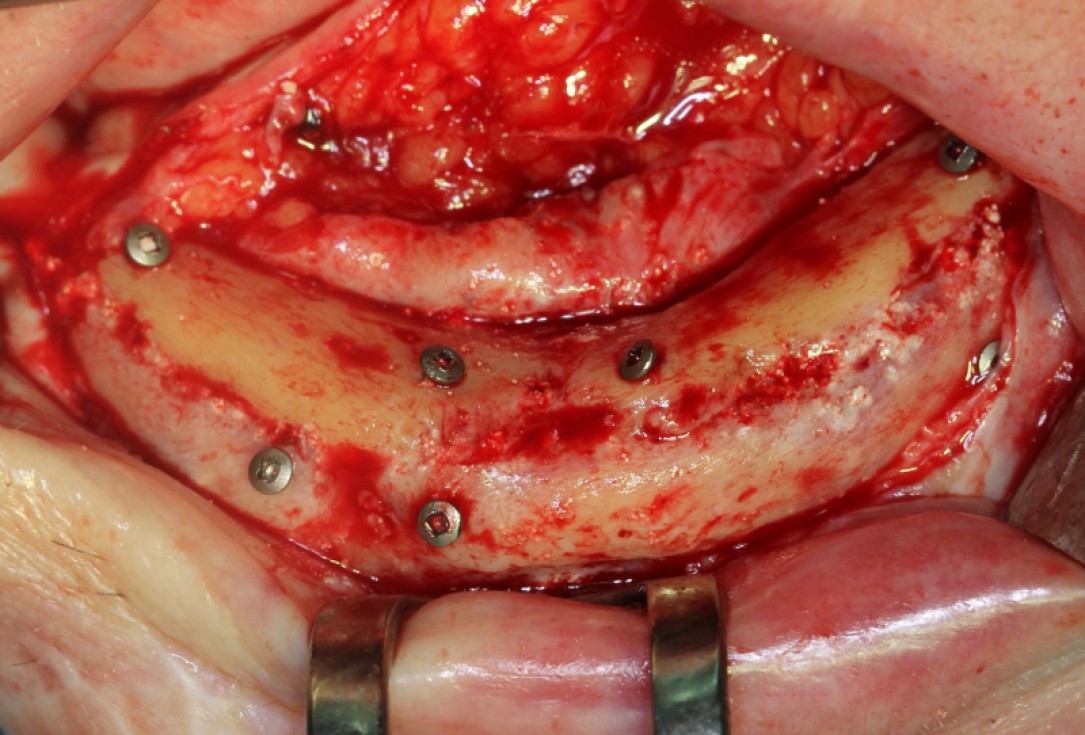 Block augmentation with maxresorb®, collprotect® membrane & autologous bone blocks - Prof. Dr. Dr. D. Rothamel