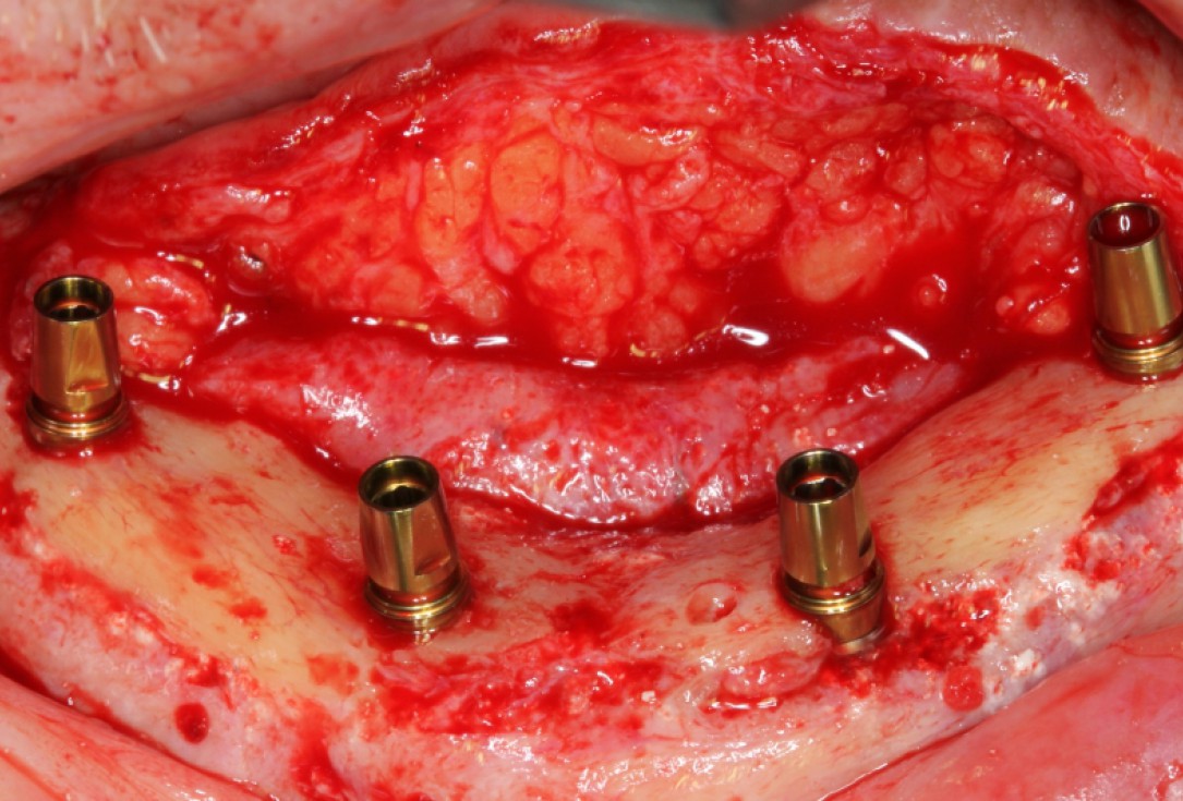 Block augmentation with maxresorb®, collprotect® membrane & autologous bone blocks - Prof. Dr. Dr. D. Rothamel