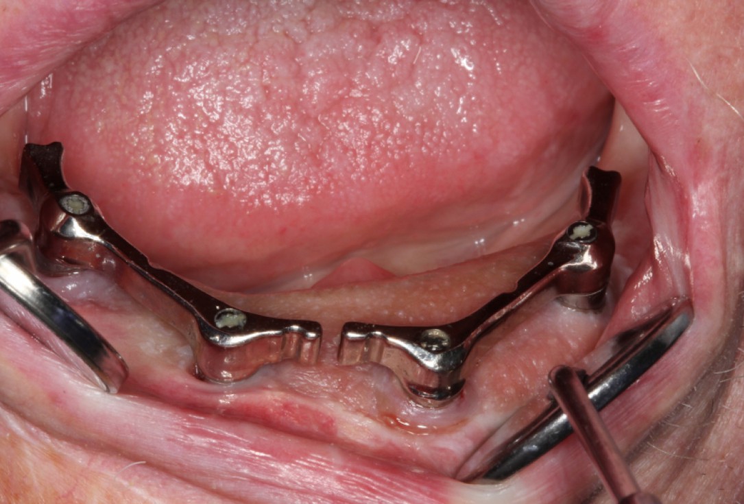 Block augmentation with maxresorb®, collprotect® membrane & autologous bone blocks - Prof. Dr. Dr. D. Rothamel