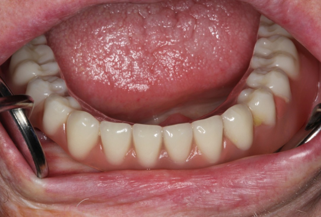 Block augmentation with maxresorb®, collprotect® membrane & autologous bone blocks - Prof. Dr. Dr. D. Rothamel