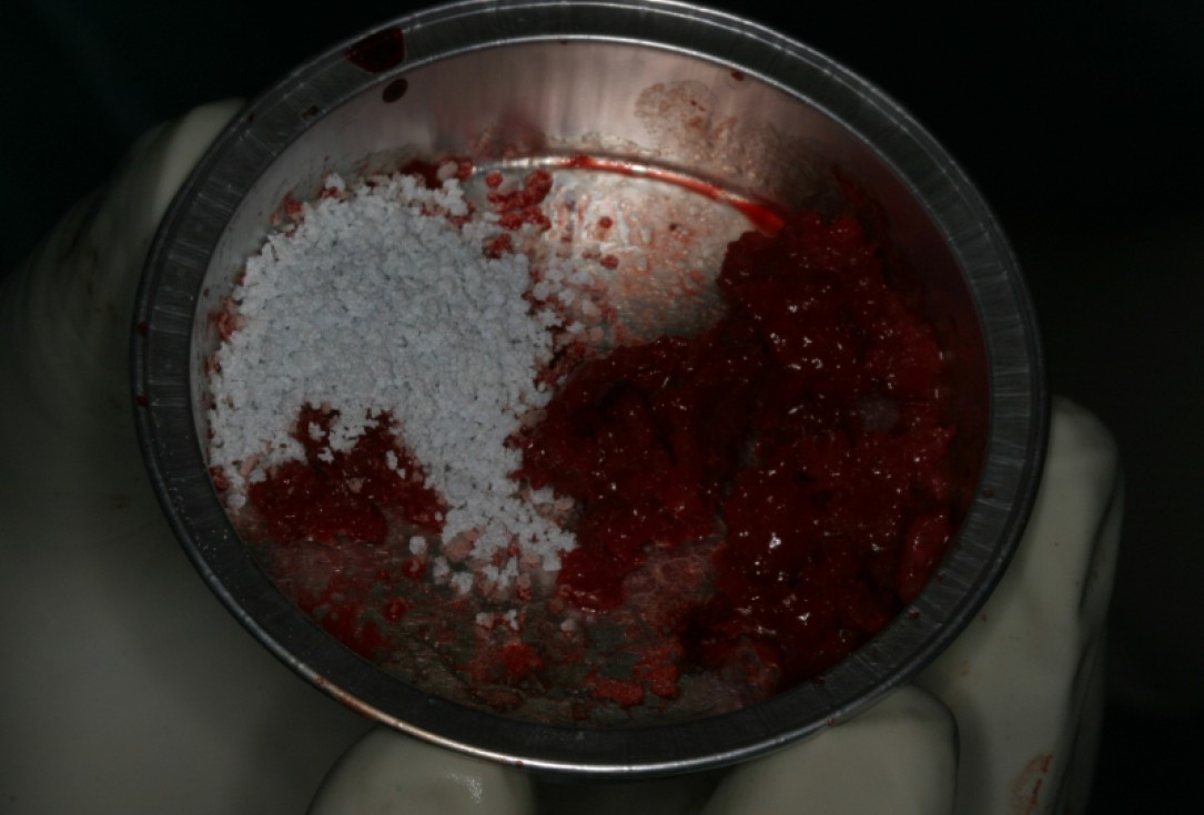 Block augmentation with maxresorb®, collprotect® membrane & autologous bone blocks - Prof. Dr. Dr. D. Rothamel