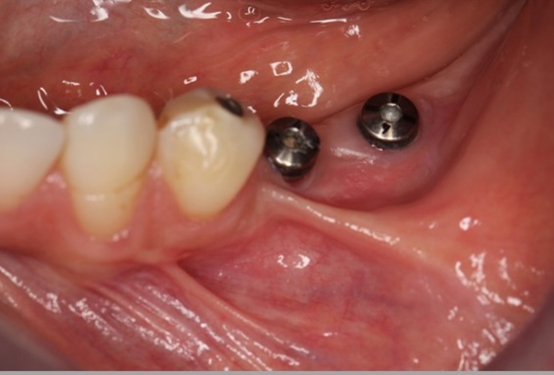 Augmentation of the mandibular attached gingiva- Stricker