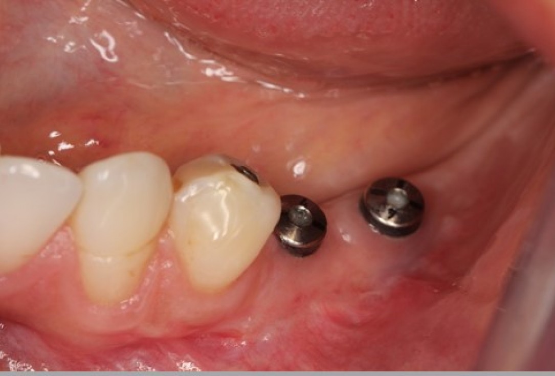 Augmentation of the mandibular attached gingiva- Stricker