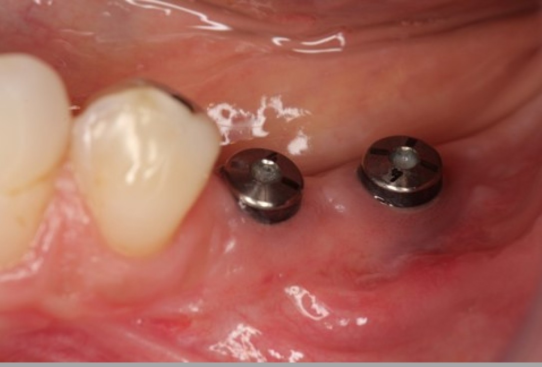 Augmentation of the mandibular attached gingiva- Stricker