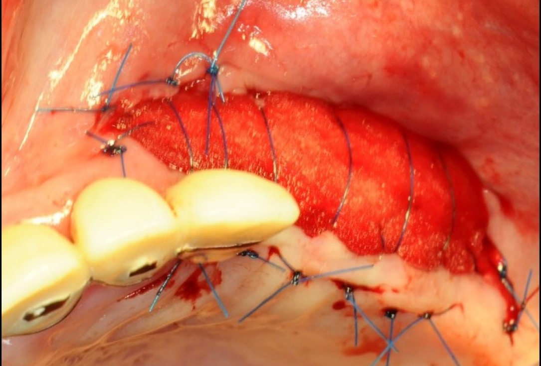 Widening of the peri-implant keratinized mucosa-Horváth
