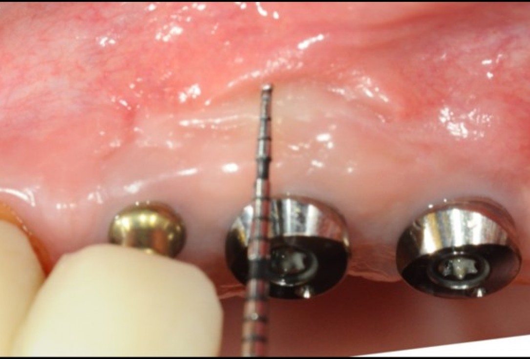 Widening of the peri-implant keratinized mucosa-Horváth