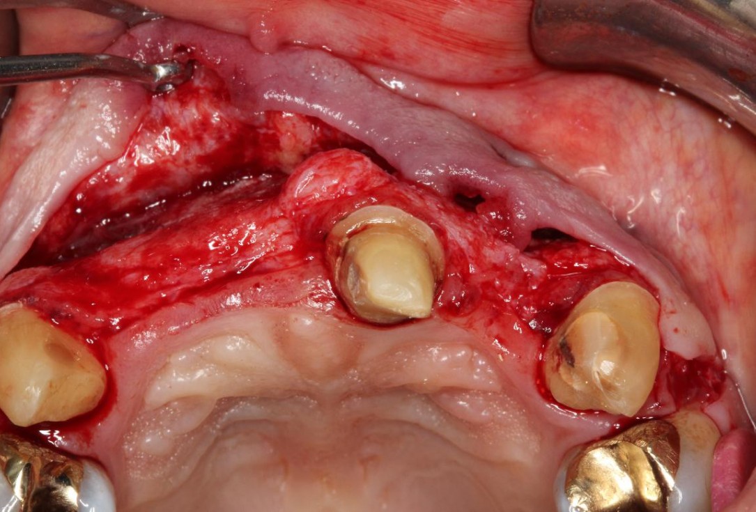 Pre-prosthetic soft tissue augmentation of the ridge contour- Rathe