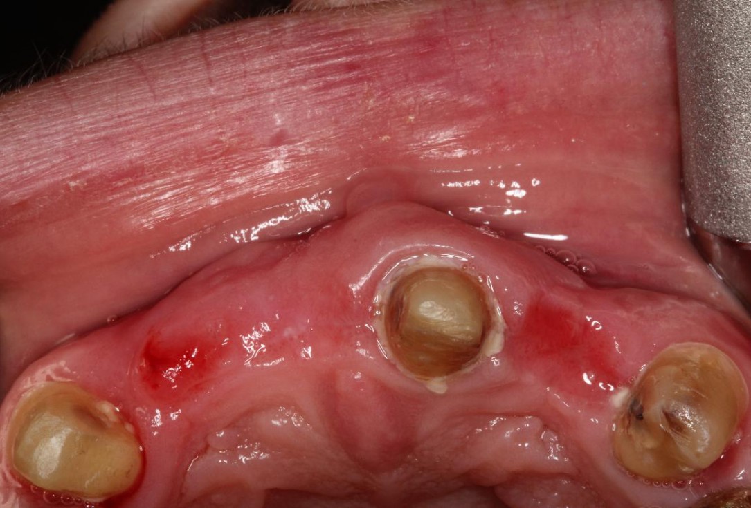 Pre-prosthetic soft tissue augmentation of the ridge contour- Rathe