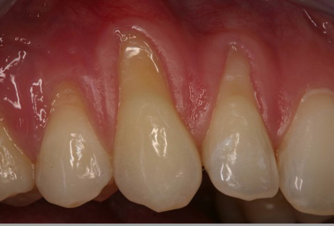 Multiple gingival recessions treated by MCAF in conjunction with mucoderm® - Kasaj