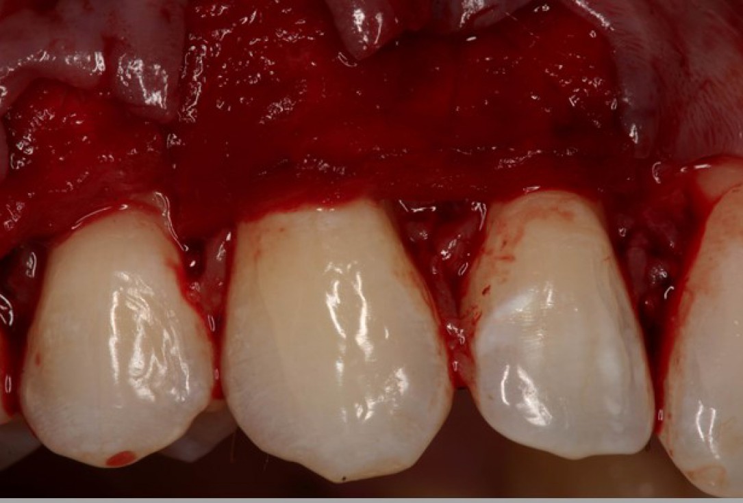 Multiple gingival recessions treated by MCAF in conjunction with mucoderm® - Kasaj