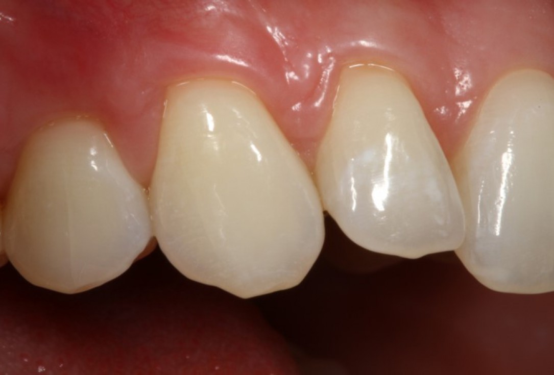 Multiple gingival recessions treated by MCAF in conjunction with mucoderm® - Kasaj