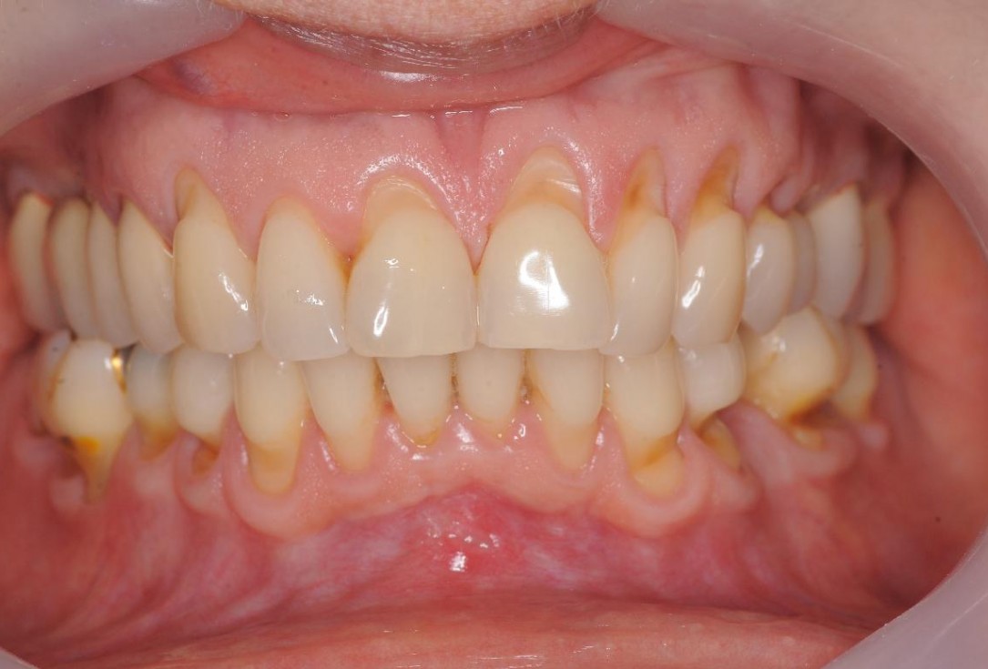 Gingival contour augmentation- Hangyási