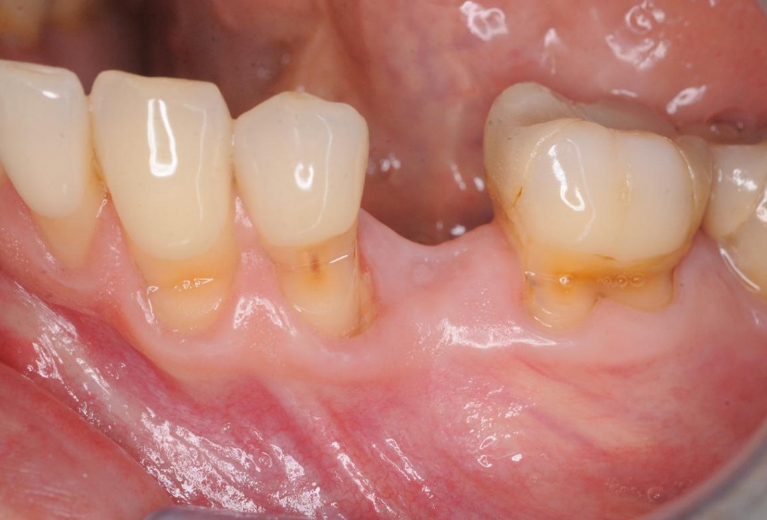Gingival contour augmentation- Hangyási