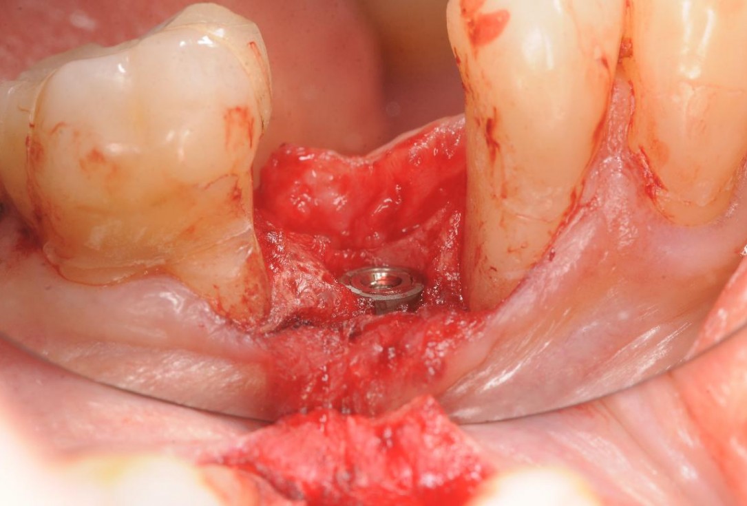 Gingival contour augmentation- Hangyási