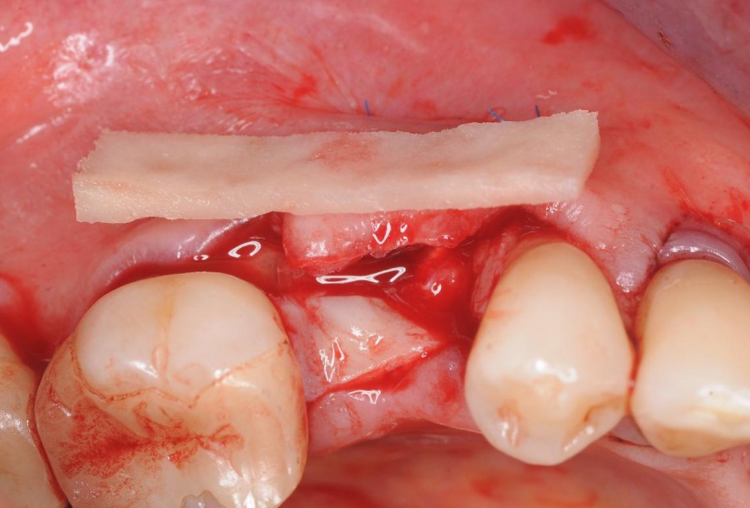 Gingival contour augmentation- Hangyási