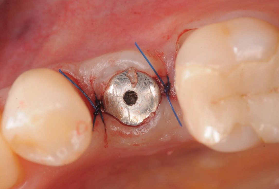 Gingival contour augmentation- Hangyási