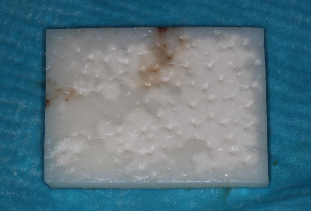 Soft tissue augmentation following ridge splitting- Rathe