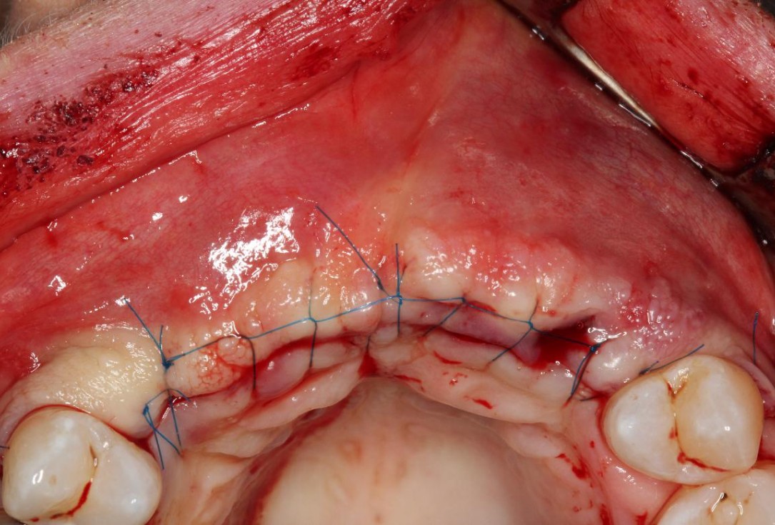 Soft tissue augmentation following ridge splitting- Rathe