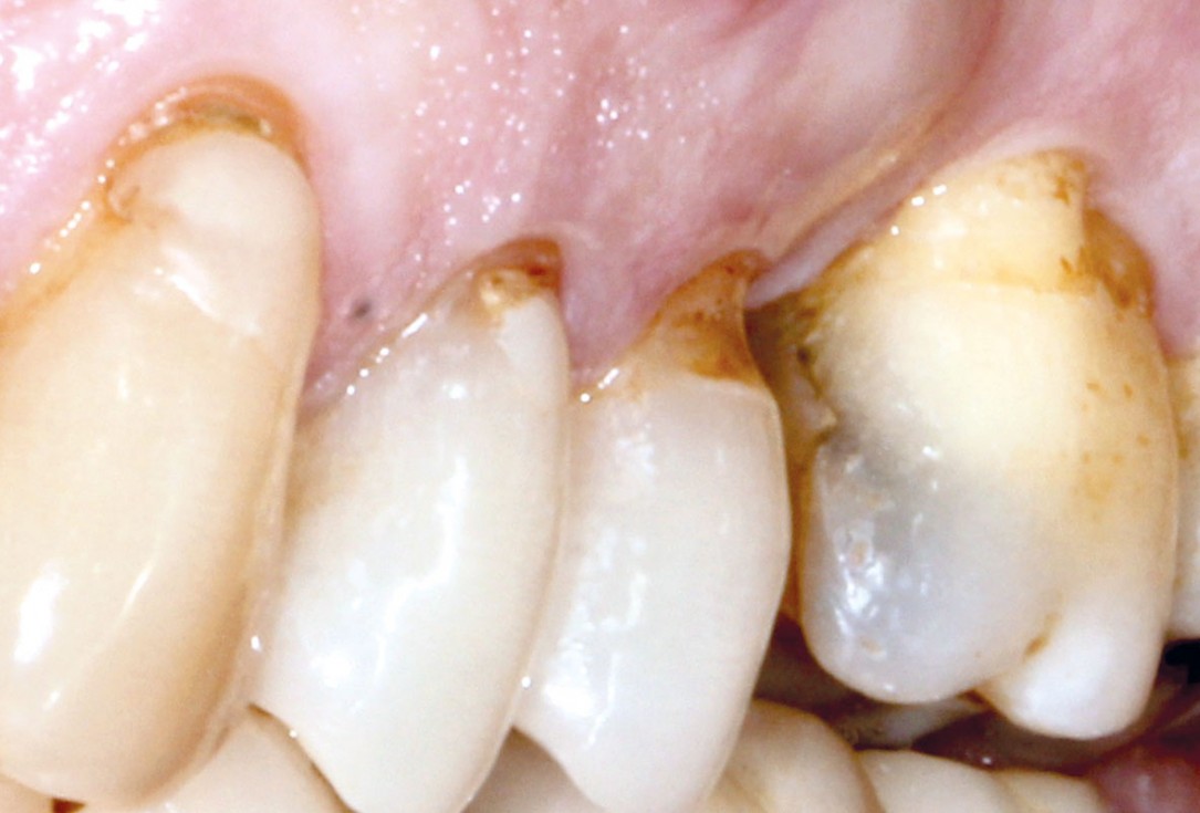 Socket preservation with permamem® - Dr. P. Papi