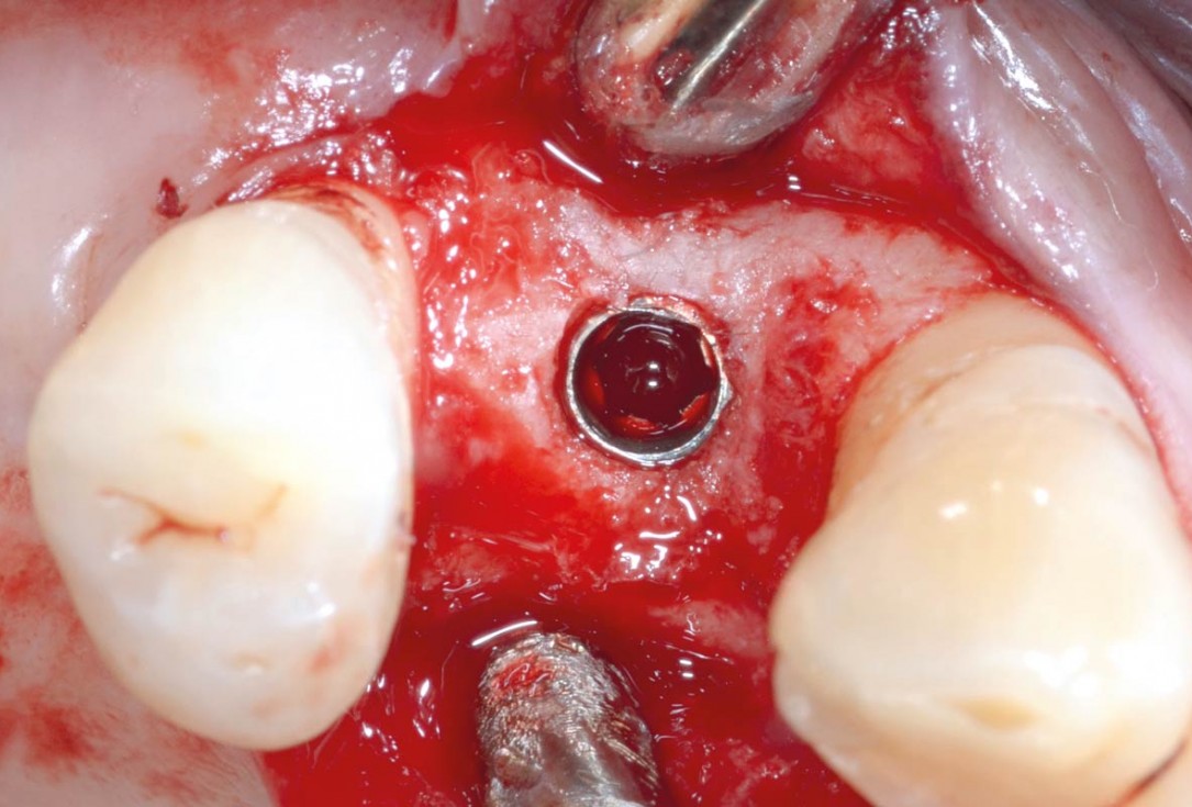 Socket preservation with permamem® - Dr. P. Papi