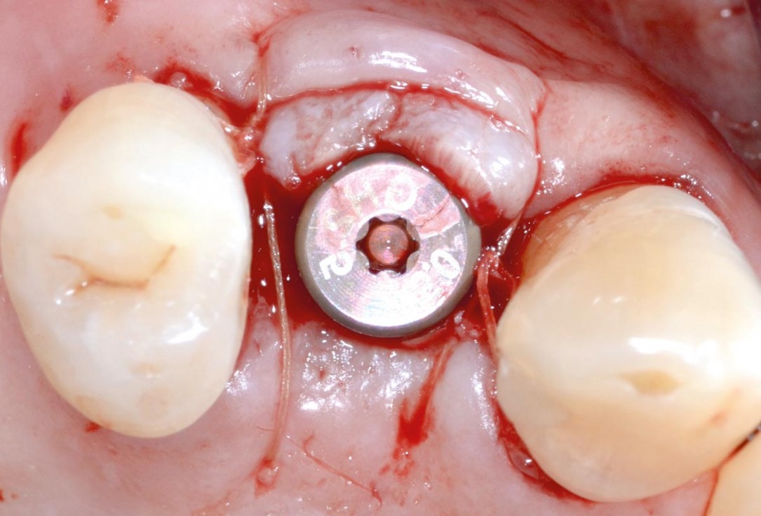 Socket preservation with permamem® - Dr. P. Papi