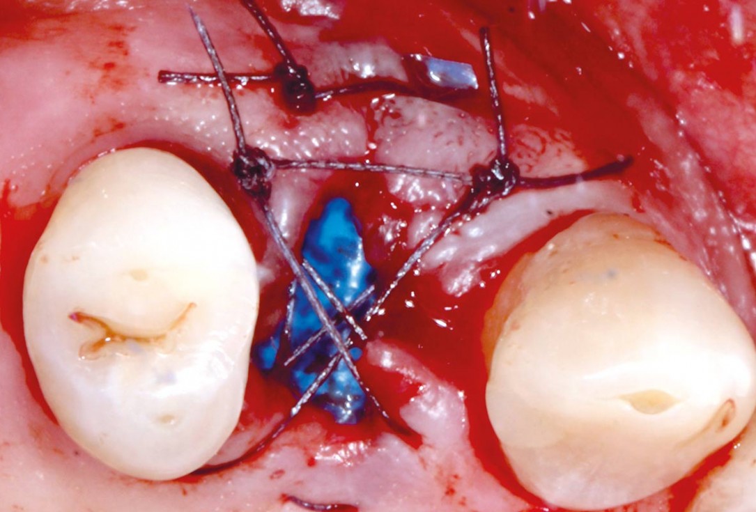 Socket preservation with permamem® - Dr. P. Papi