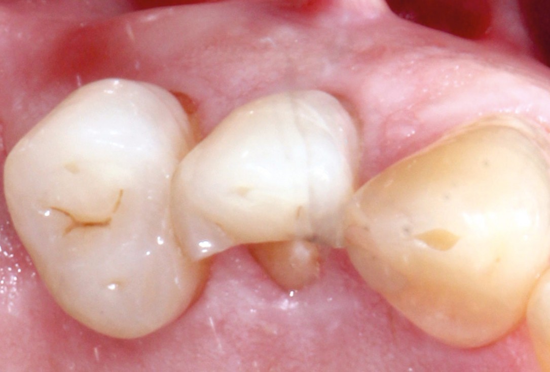 Socket preservation with permamem® - Dr. P. Papi