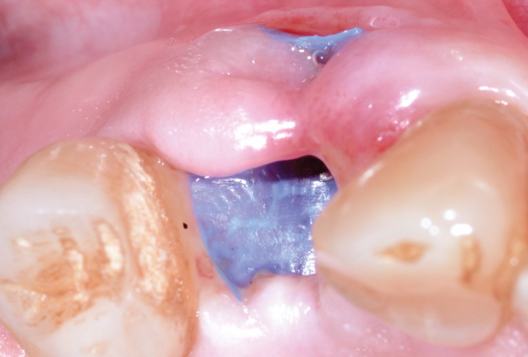 Socket preservation with permamem® - Dr. P. Papi