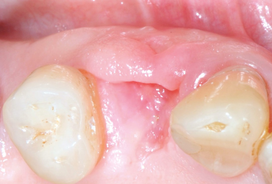 Socket preservation with permamem® - Dr. P. Papi