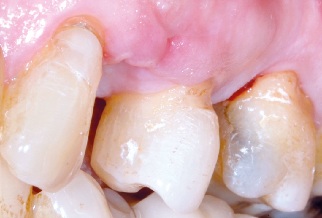 Socket preservation with permamem® - Dr. P. Papi