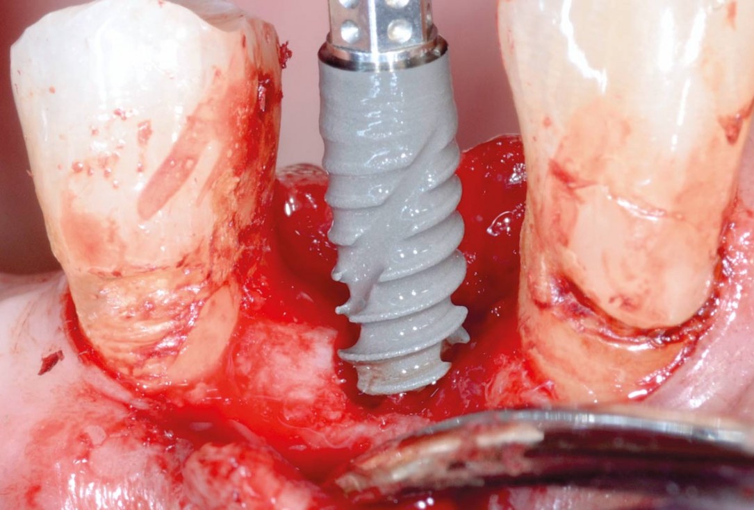 Socket preservation with permamem® - Dr. P. Papi