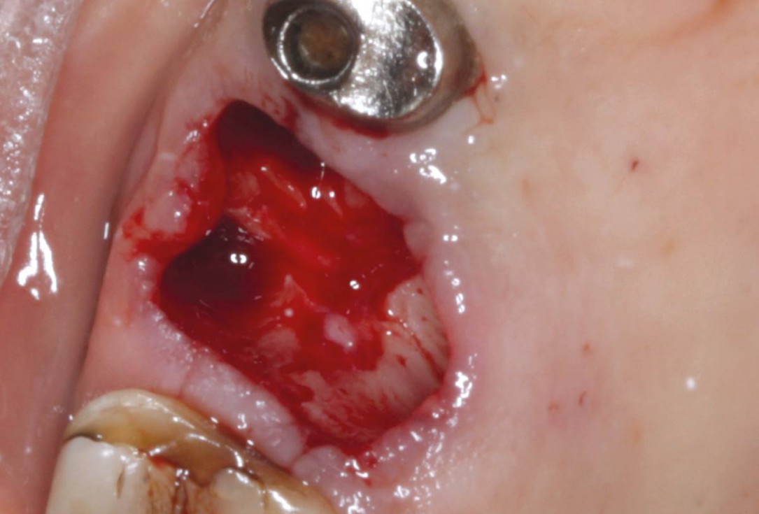 Socket preservation with permamem® - Dr. M. Turco