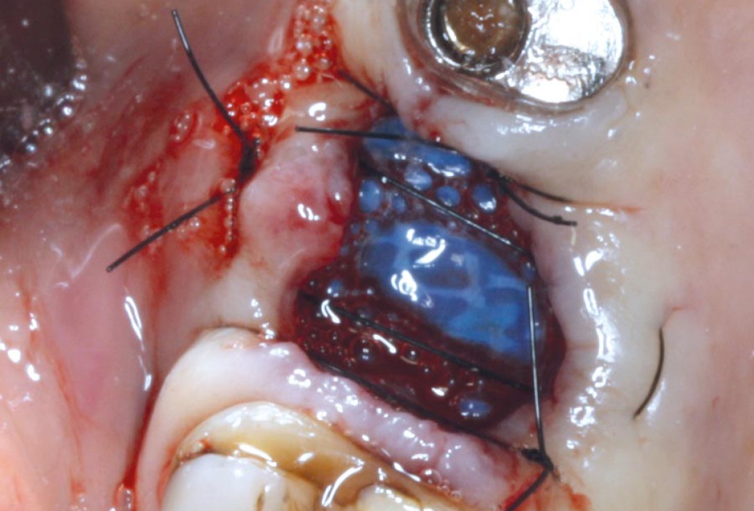 Socket preservation with permamem® - Dr. M. Turco