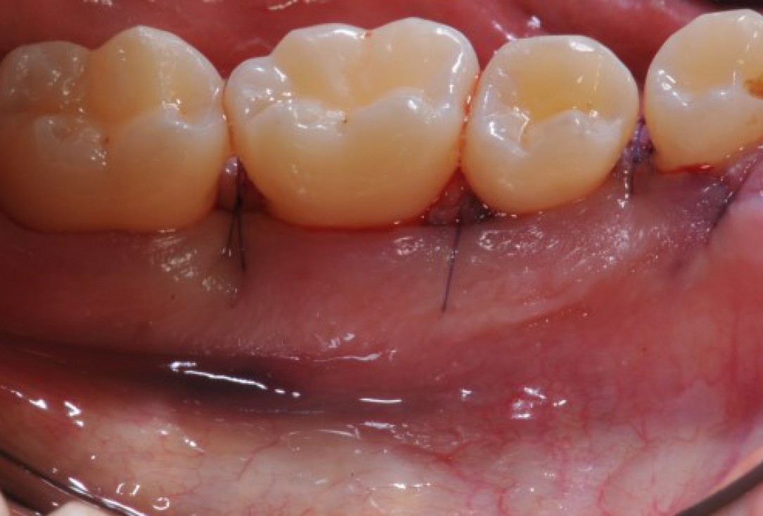 Deep intrabony defects treated using Straumann® Emdogain® - Dr. M. Stefanini