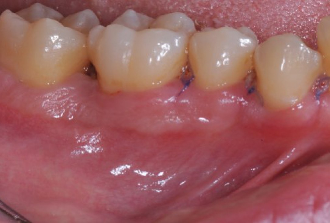 Deep intrabony defects treated using Straumann® Emdogain® - Dr. M. Stefanini