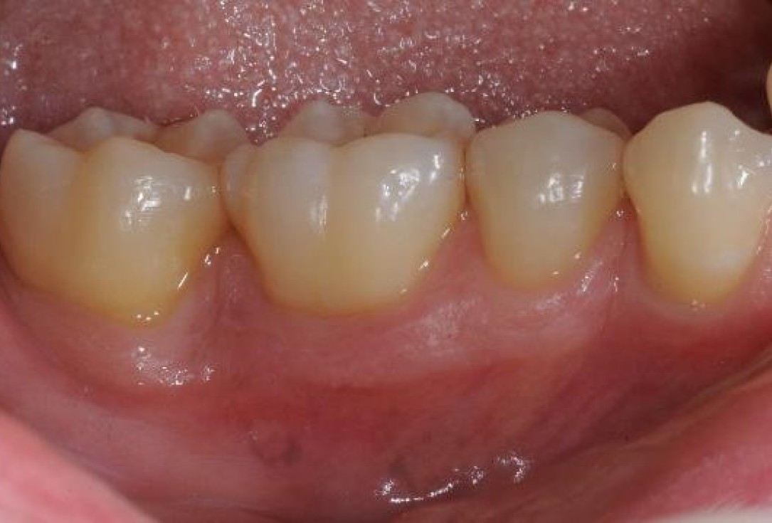 Deep intrabony defects treated using Straumann® Emdogain® - Dr. M. Stefanini