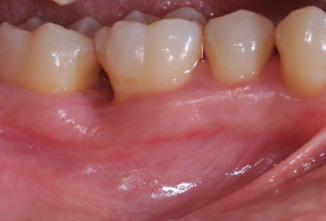 Deep intrabony defects treated using Straumann® Emdogain® - Dr. M. Stefanini