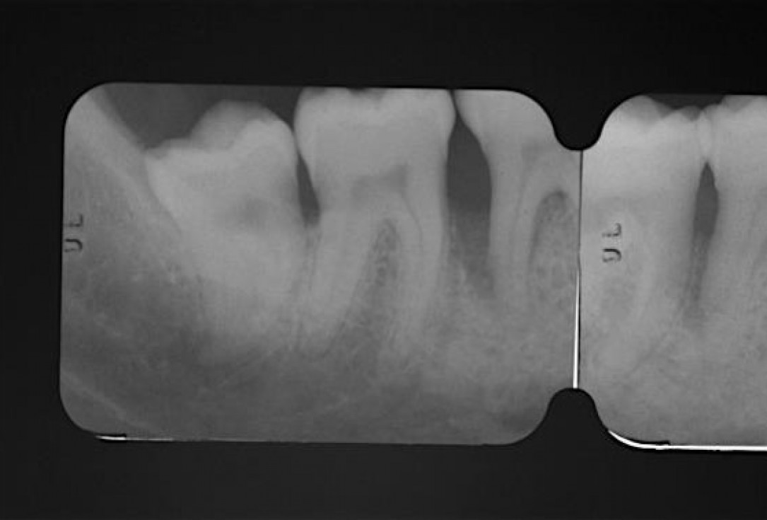 Deep intrabony defects treated using Straumann® Emdogain® - Dr. M. Stefanini