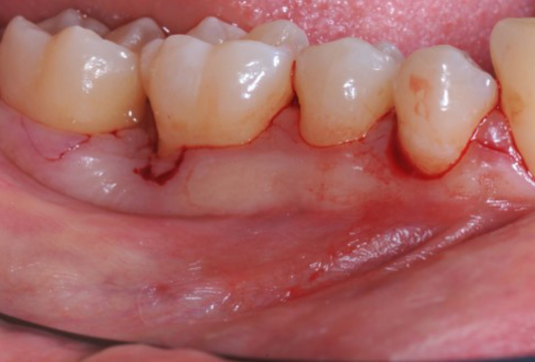 Deep intrabony defects treated using Straumann® Emdogain® - Dr. M. Stefanini