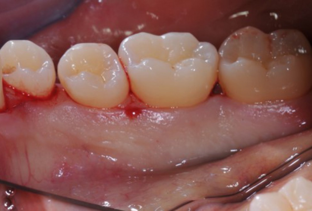 Deep intrabony defects treated using Straumann® Emdogain® - Dr. M. Stefanini