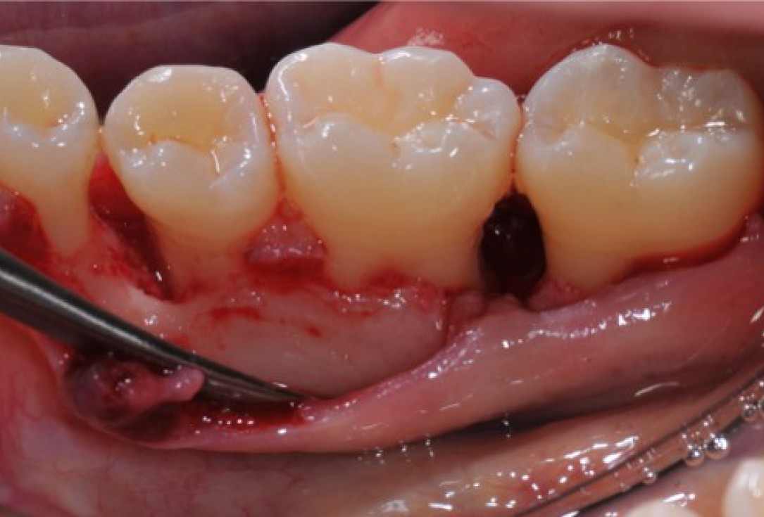 Deep intrabony defects treated using Straumann® Emdogain® - Dr. M. Stefanini
