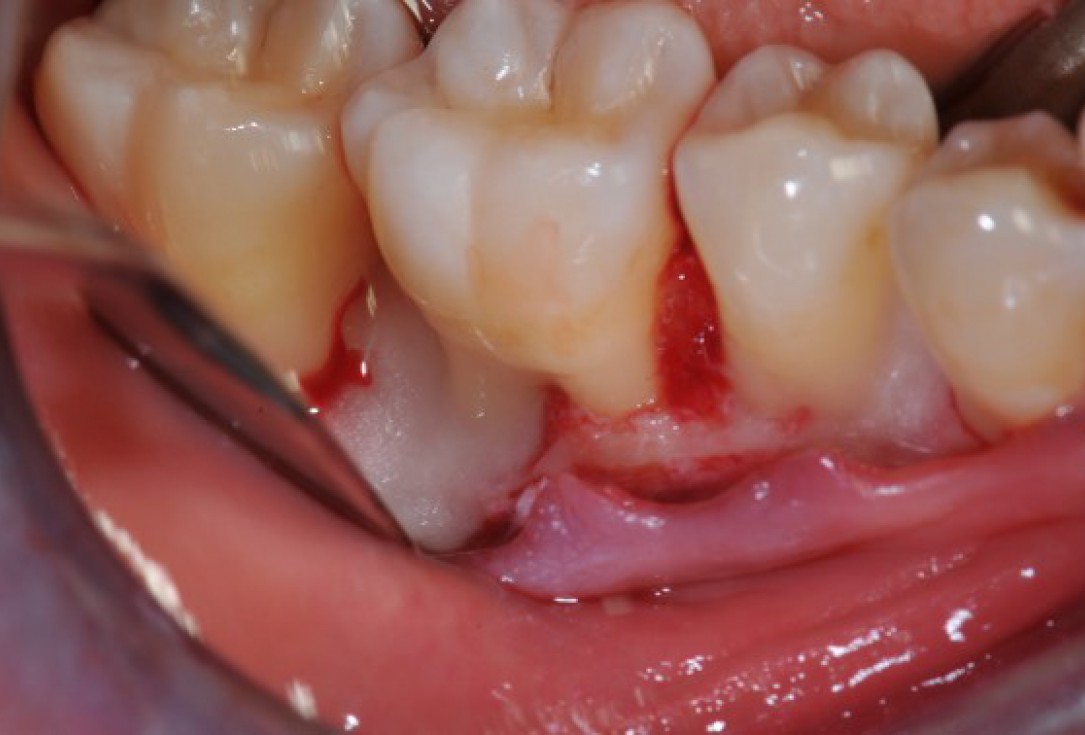 Deep intrabony defects treated using Straumann® Emdogain® - Dr. M. Stefanini