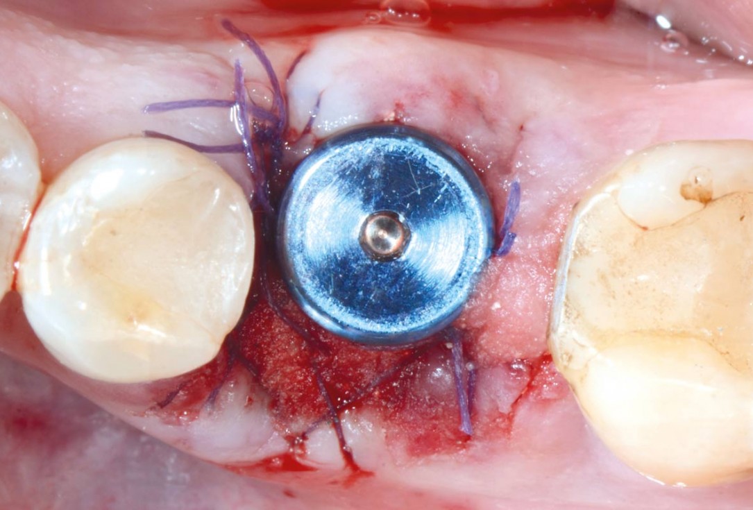 Immediate implant placement in the mandibular with collacone® max – Dr. D. Jelušić
