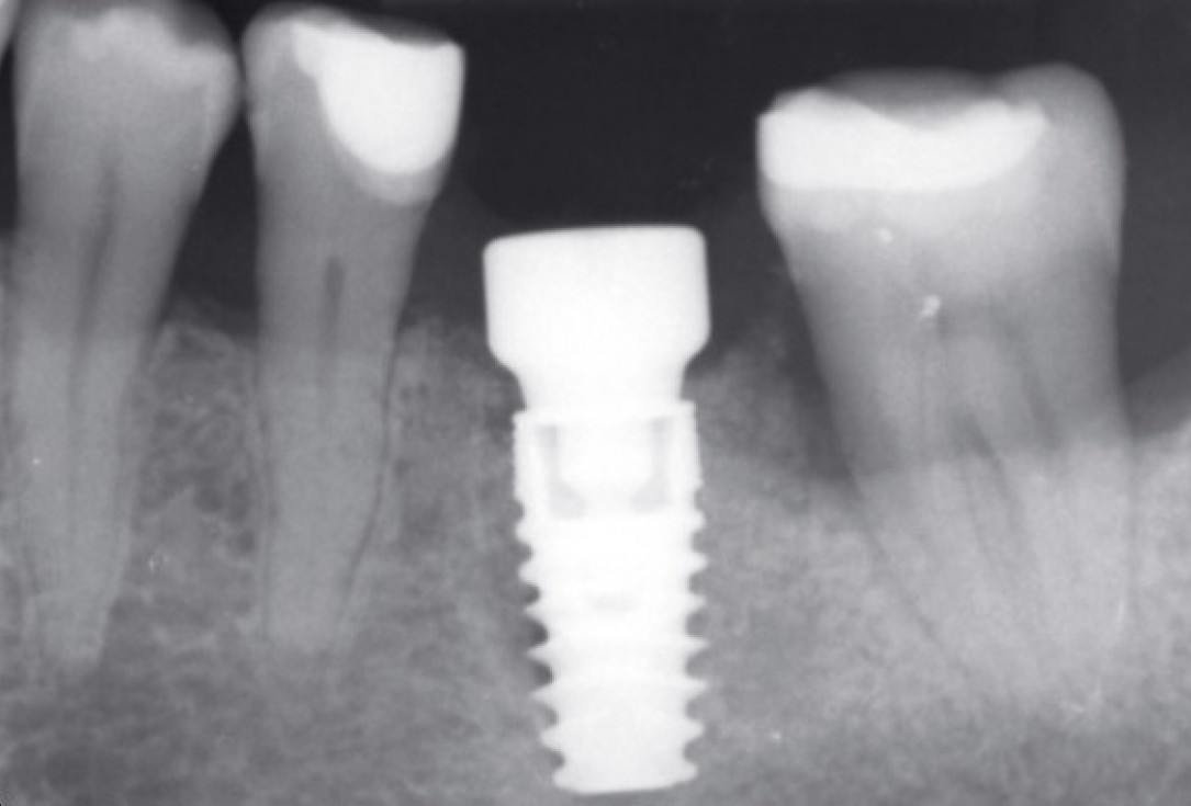 Immediate implant placement in the mandibular with collacone® max – Dr. D. Jelušić