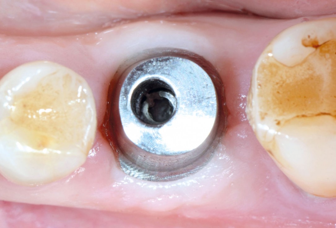 Immediate implant placement in the mandibular with collacone® max – Dr. D. Jelušić