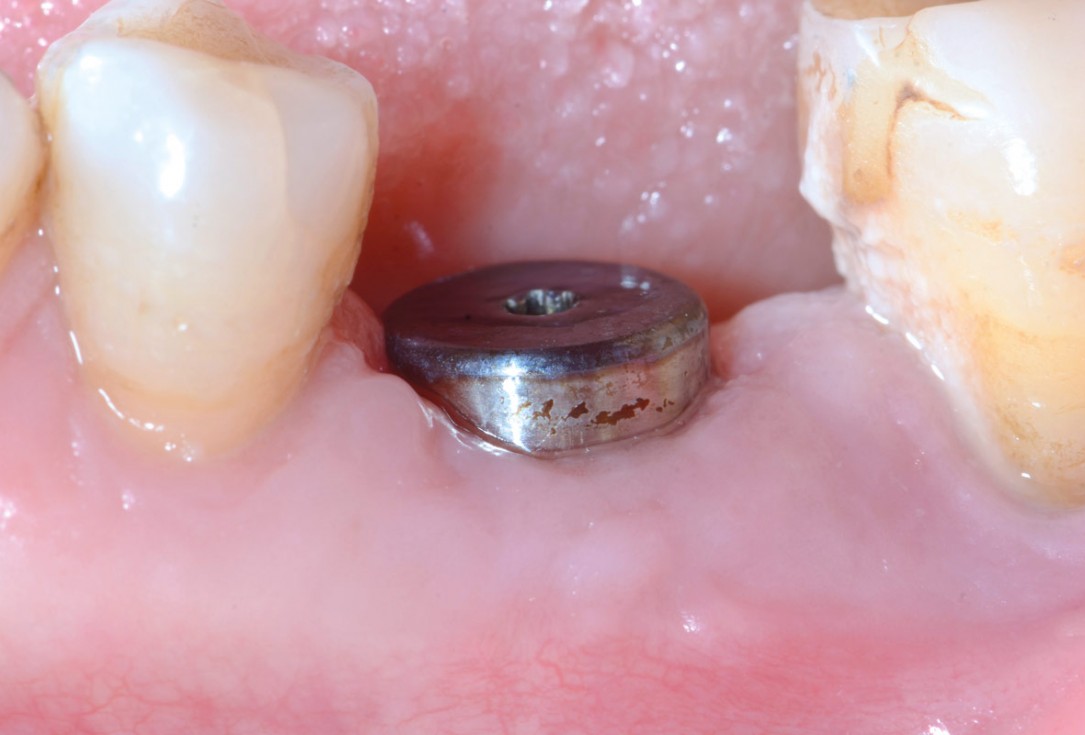 Immediate implant placement in the mandibular with collacone® max – Dr. D. Jelušić