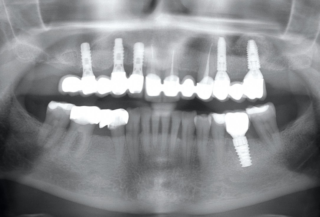 Immediate implant placement in the mandibular with collacone® max – Dr. D. Jelušić